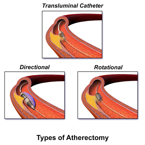 File:Blausen 0064 Atherectomy.png