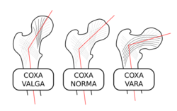 Coxa-valga-norma-vara-000.svg