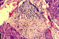 A histological image of an inflammatory infiltration of the islets of Langerhans of the pancreas