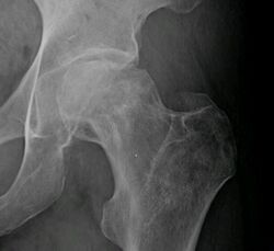 Osteonecrosis femur 1.jpg