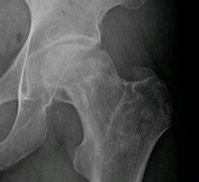 File:Osteonecrosis femur 1.jpg
