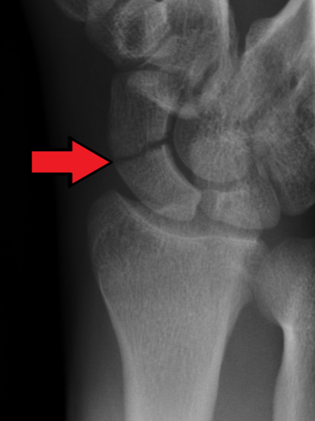 File:X-ray of scaphoid fracture.png