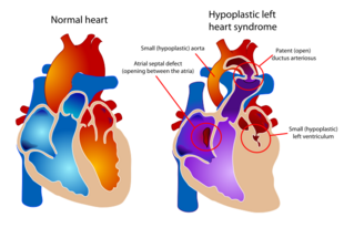Hypoplastic left heart syndrome.svg