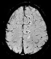 Susceptibility weighted imaging (SWI) in diffuse axonal injury.jpg