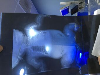 X ray for osteogenesis imperfecta.jpg