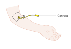 Diagram showing a cannula