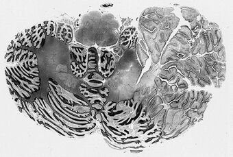 Dysplastic cerebellar gangliocytoma.jpg