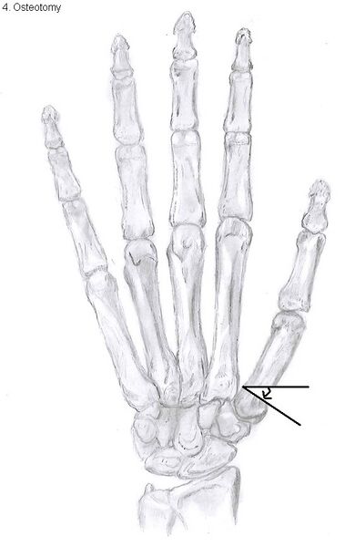 File:Osteotomy of the thumb.jpg