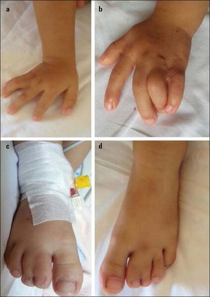 File:PMC5336871 Ergul 2015 Timothy syndrome syndactyly.jpg