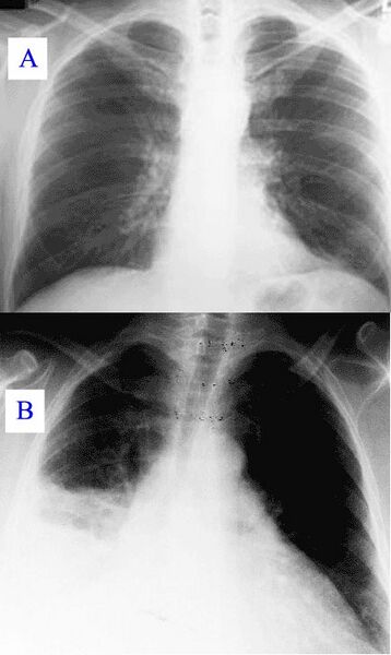 File:Pneumonia x-ray.jpg