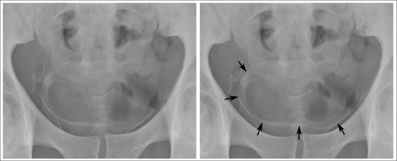 File:Schistosomiaisis Bladder Calcifications.png