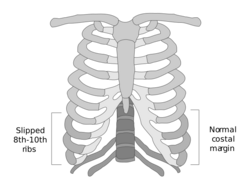 Slipping Rib Syndrome Example.svg