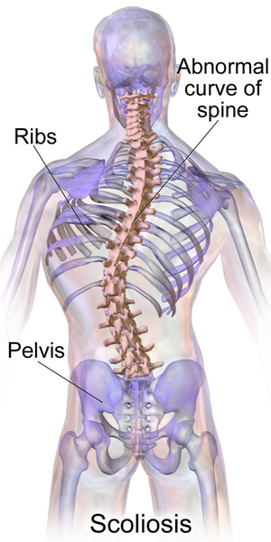 File:Blausen 0785 Scoliosis 01.png