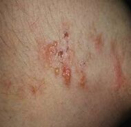 Dermatitis herpetiformis.jpg