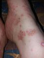 IgA bullous dermatosis.jpg