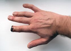 Index finger amputation.jpg