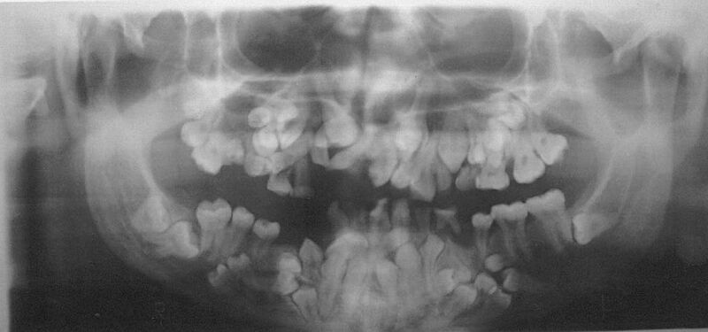 File:Cleidocranial dysplasia teeth.jpg