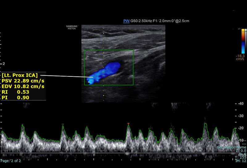 File:Left proximal internal carotid artery normal spectral doppler.jpg