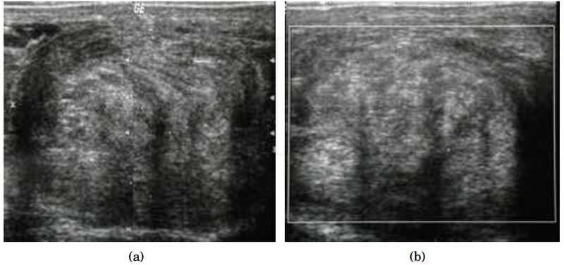 File:Scrotal ultrasonography of leiomyoma.jpg