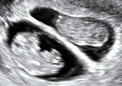 Dichorionic twins with heart activity at 8w5d since co-incubation.gif