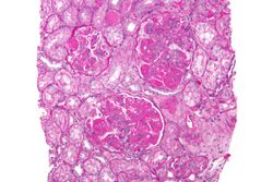 Diffuse proliferative lupus nephritis - high mag.jpg