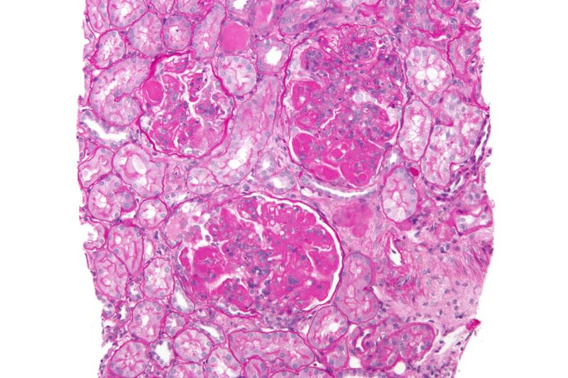 File:Diffuse proliferative lupus nephritis - high mag.jpg