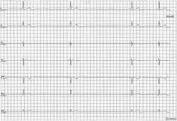 ECG Sinus Pause.jpg