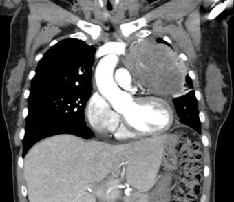 Thymuskarzinom Plattenepithel - CT coronar - 001.jpg