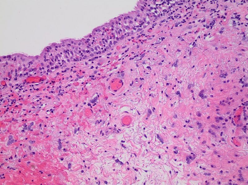 File:Histopathology of radiation cystitis.jpg