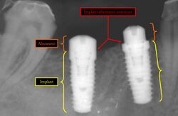 Implant-Abutment Junction.jpg