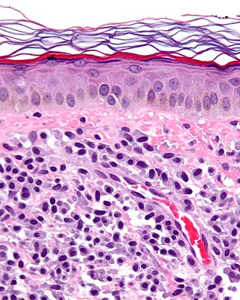Mastocytosis - cropped - very high mag.jpg