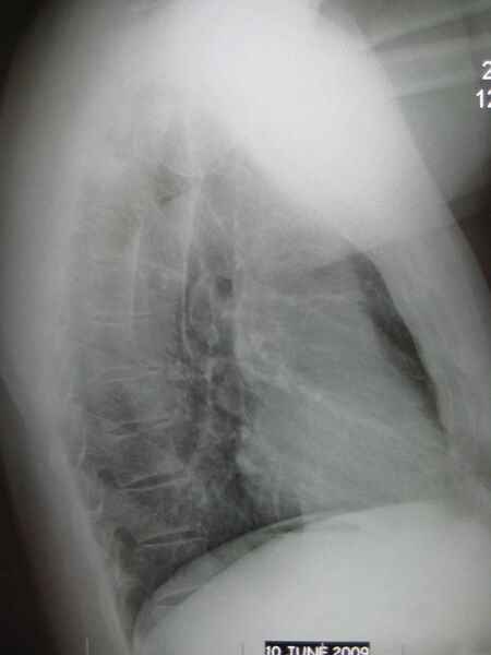 File:Normal lateral chest x-ray.jpg