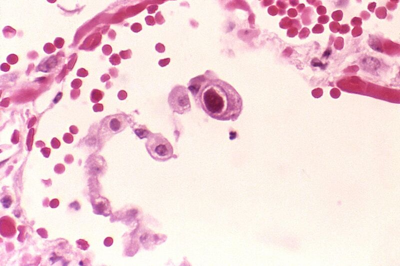 File:Cytomegalovirus 01.jpg