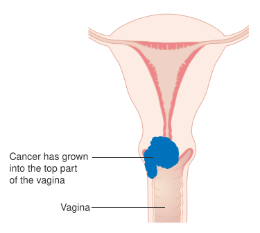 File:Diagram showing stage 2A cervical cancer CRUK 212.svg