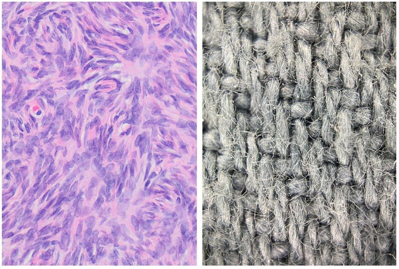 File:Histopathology of woven or storiform pattern.jpg