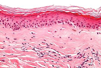 Lichen sclerosus - very high mag.jpg