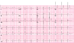 Brugada syndrome type2 example1 (CardioNetworks ECGpedia).png