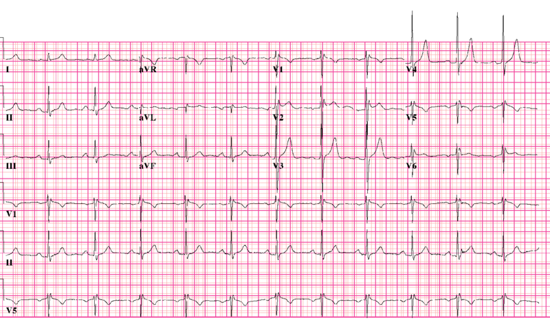 File:Brugada syndrome type2 example1 (CardioNetworks ECGpedia).png