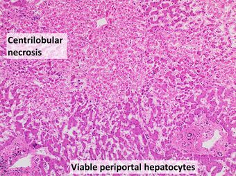 Histopathology of shock liver (intermediate magnification), annotated.jpg