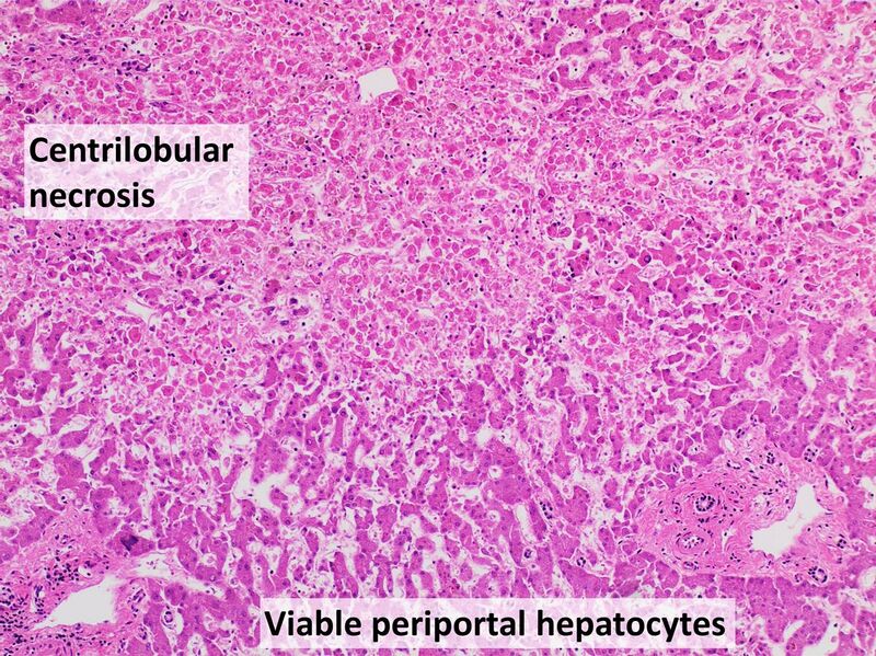 File:Histopathology of shock liver (intermediate magnification), annotated.jpg