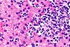 Lobular necro-inflammation with histiocyte cluster -- very high mag.jpg