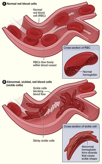 Sickle cell 01.jpg