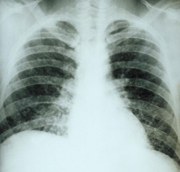 File:Chest X-ray acute pulmonary histoplasmosis PHIL 3954.jpg
