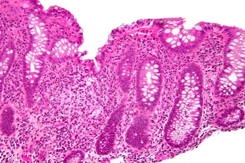 File:Colitis with granuloma intermed mag.jpg