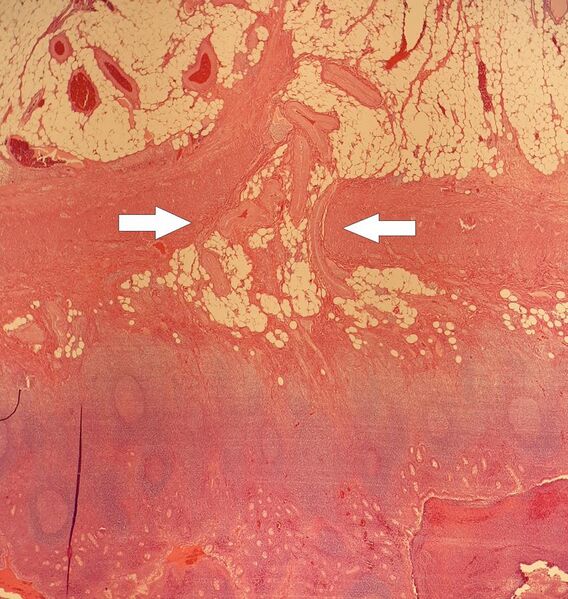 File:Micrograph of entry point of appendicular arteries.jpg