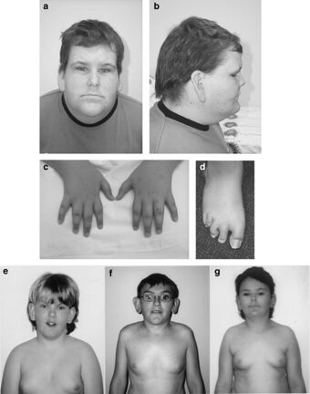 Börjeson-Forssman-Lehmann syndrome in males.jpg