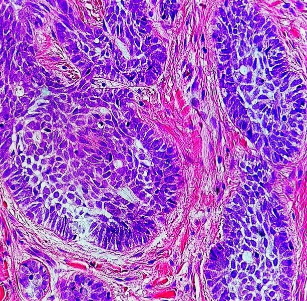 File:High-magnification micrograph of basal-cell carcinoma.jpg