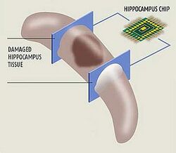 Hippocampal Prosthesis.jpg