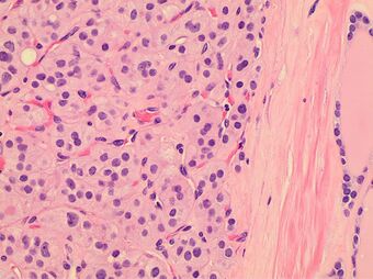 Histopathology of a Hürthle cell adenoma.jpg