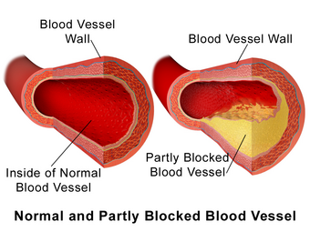 Blausen 0052 Artery NormalvPartially-BlockedVessel.png